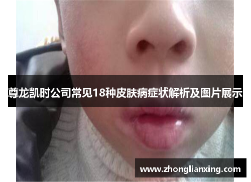 尊龙凯时公司常见18种皮肤病症状解析及图片展示